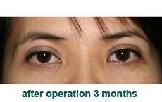 plastic-surgery-blepharoplasty